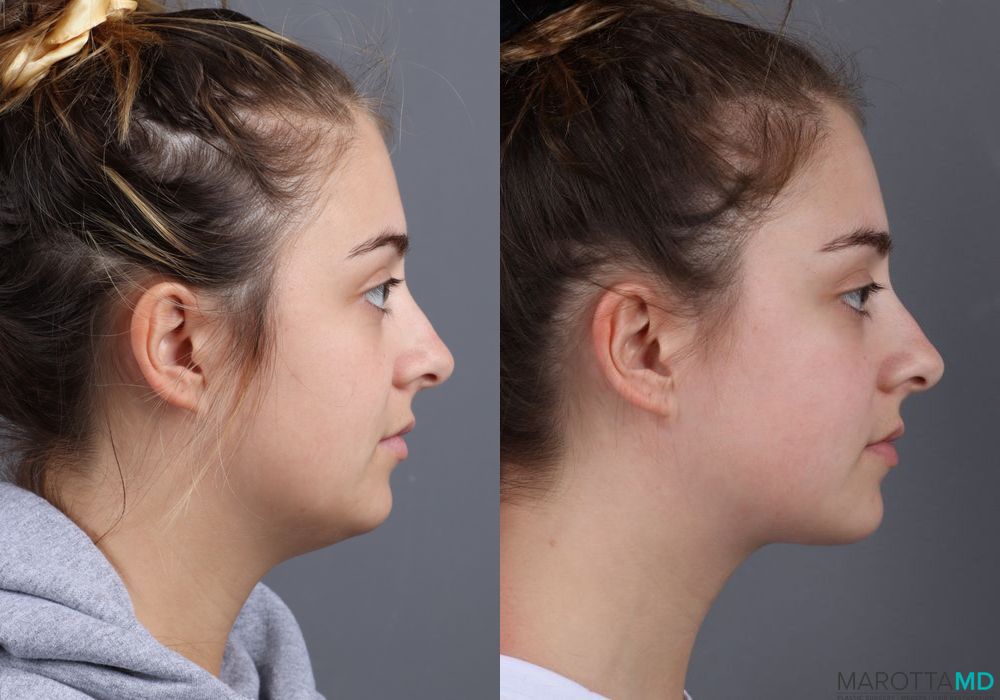 Renuvion - Thumbnail 2