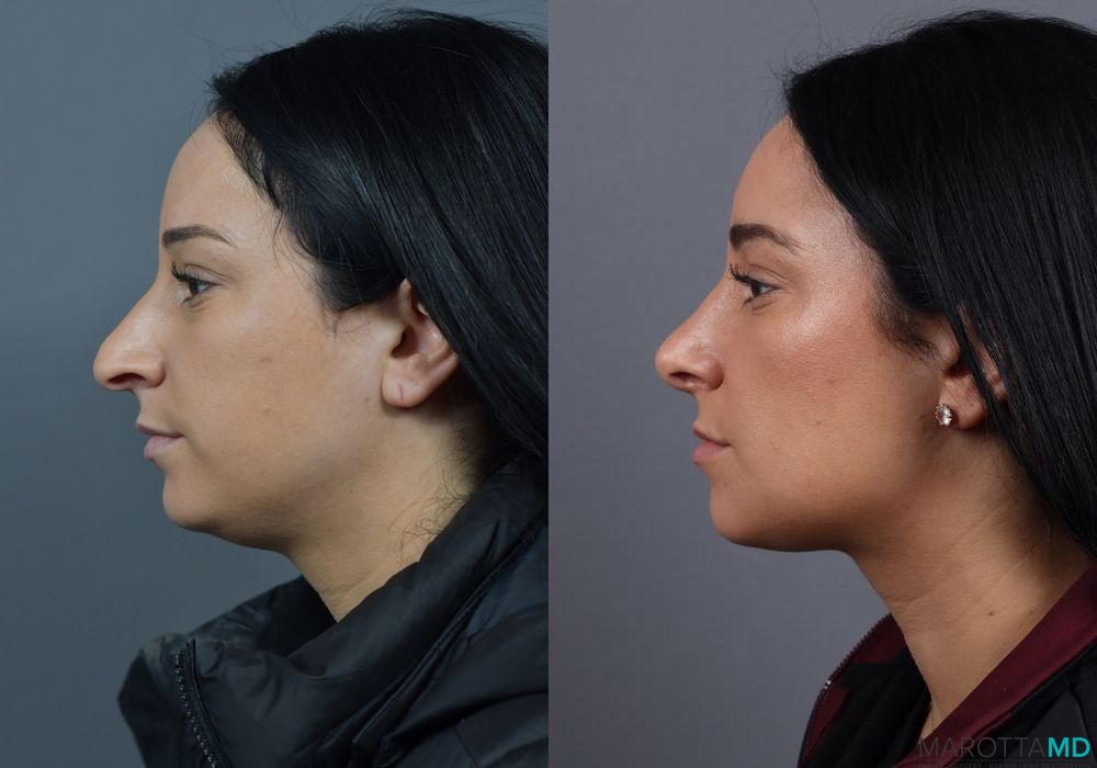Before and after Rhinoplasty case 7229 - Angle 3