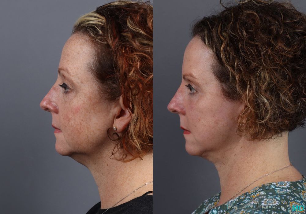 Mini Facelift - Thumbnail 3