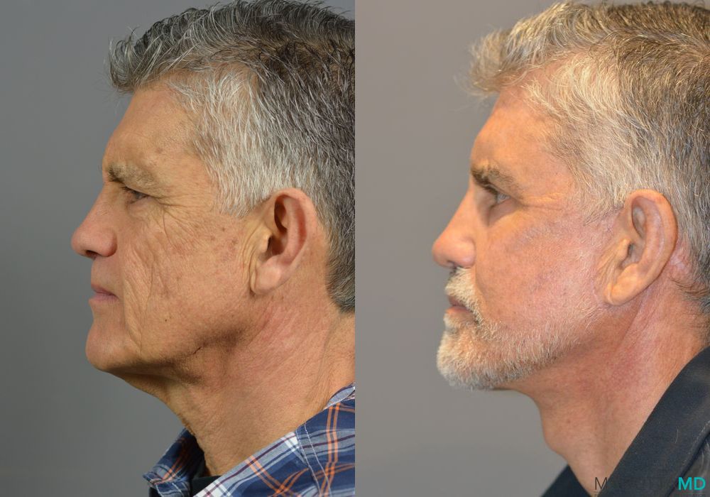 Facelift & Neck Lift - Thumbnail 4