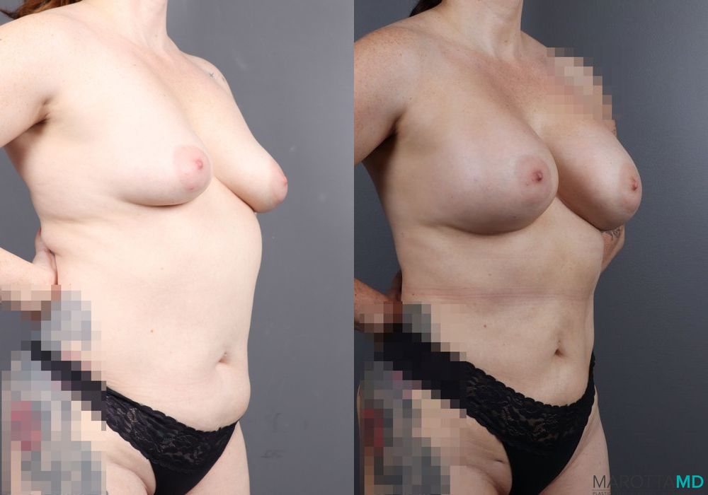 Before and after Breast Augmentation case 7079 - Angle 5