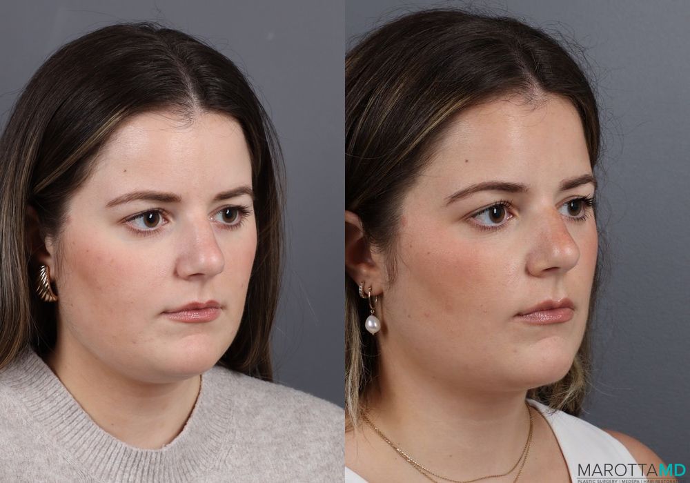 Before and after Skin Tightening Face case 7265 - Angle 2
