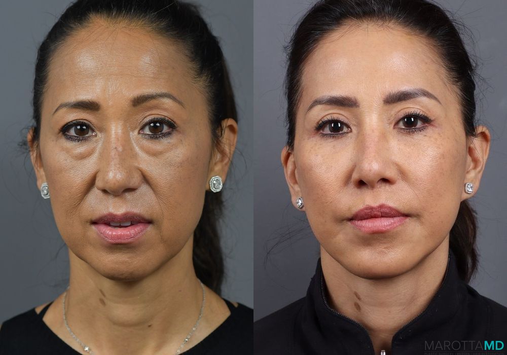 Mini Facelift - Thumbnail 4