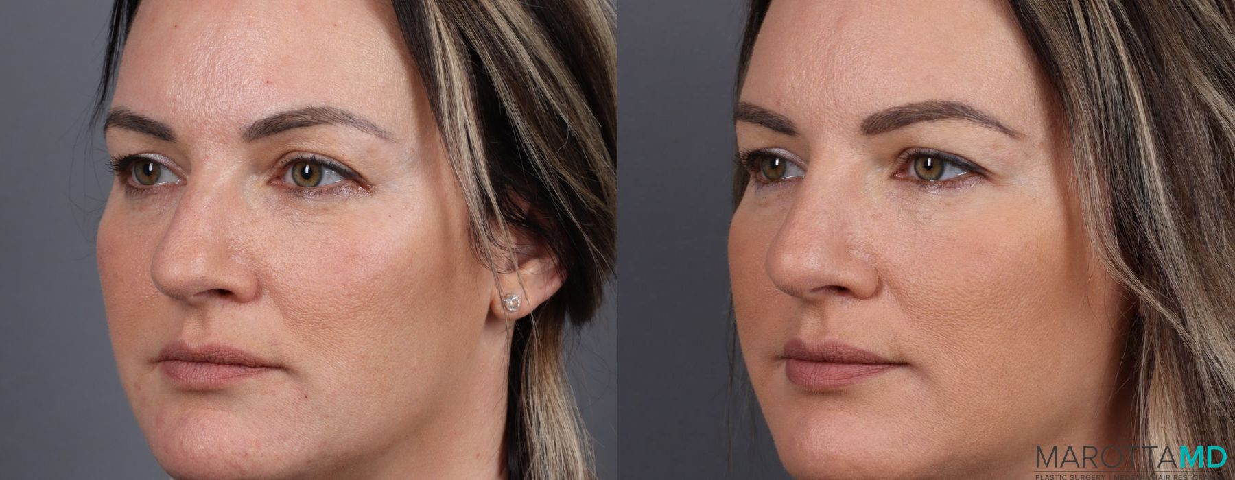 Non-Surgical Rhinoplasty - Thumbnail 2