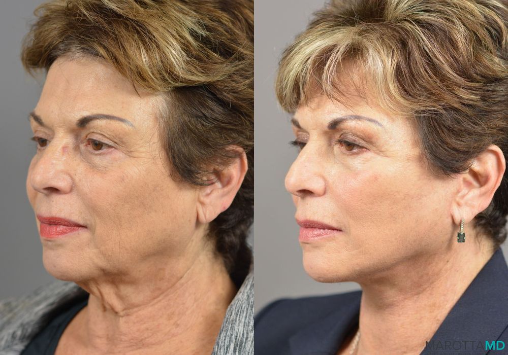 Before and after Facelift & Neck Lift case 7023 - Angle 2