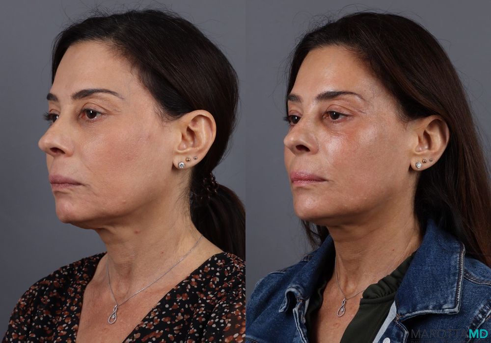 Before and after BOTOX® Cosmetic case 7267 - Angle 3