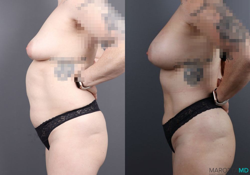 Before and after Breast Augmentation case 7079 - Angle 2
