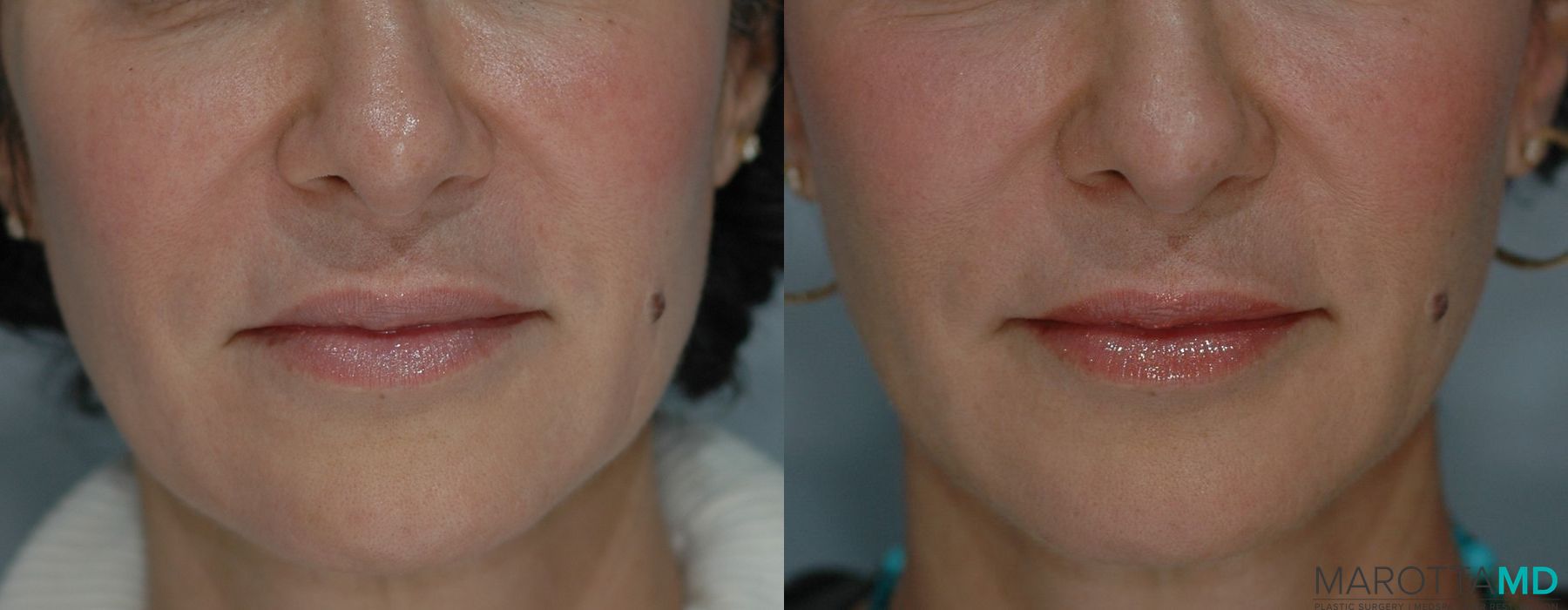 Ultherapy® - Case 1271