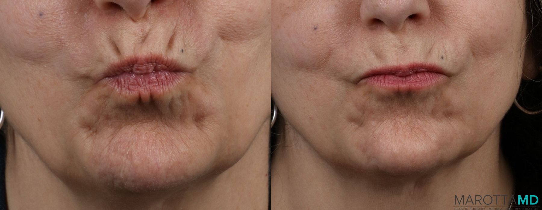 Before and after Botox - Forehead case 7153 - Angle 3