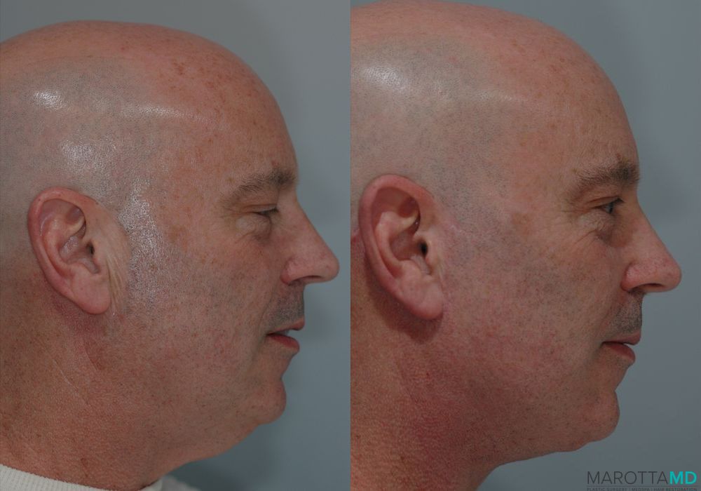 Facelift & Neck Lift - Thumbnail 3