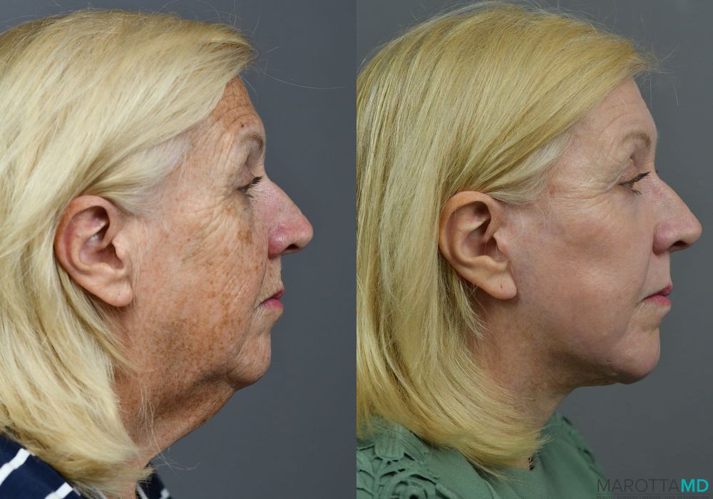 Laser Skin Resurfacing - Face - Thumbnail 5