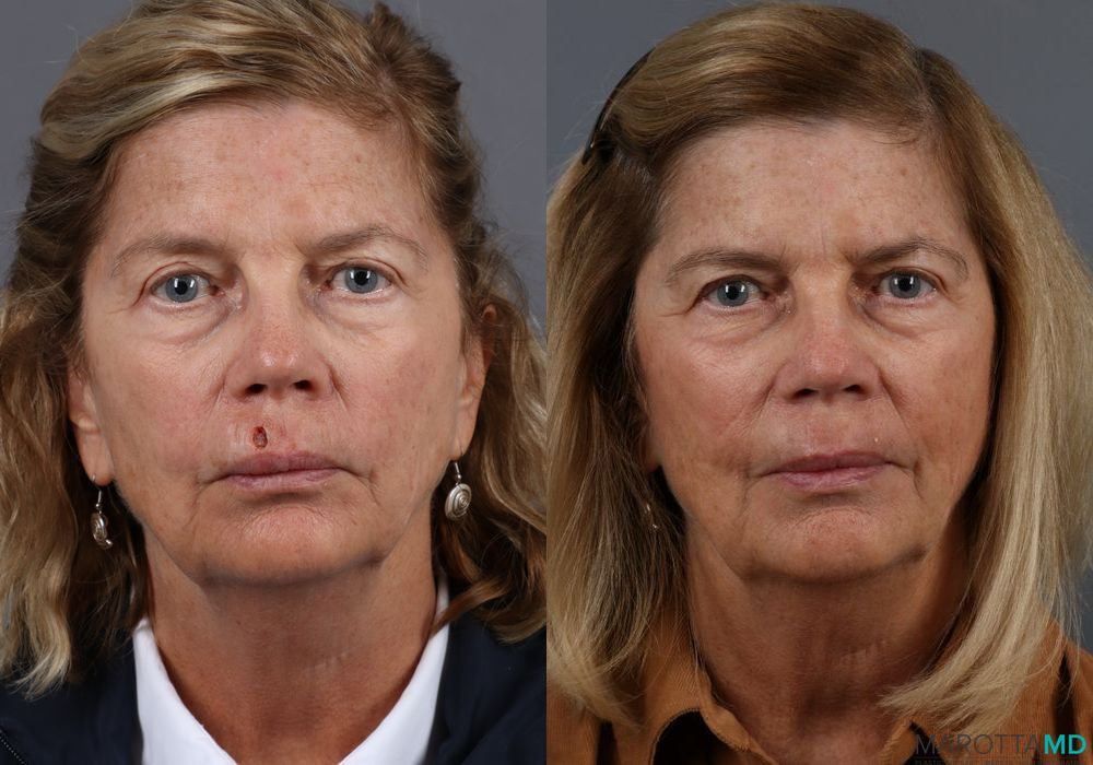 Skin Cancer Reconstruction - Face - Case 275