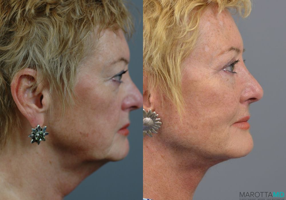 Facelift & Neck Lift - Thumbnail 3