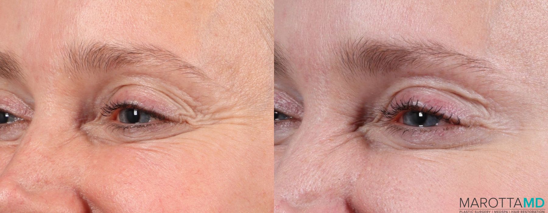 BOTOX® Cosmetic - Thumbnail 3