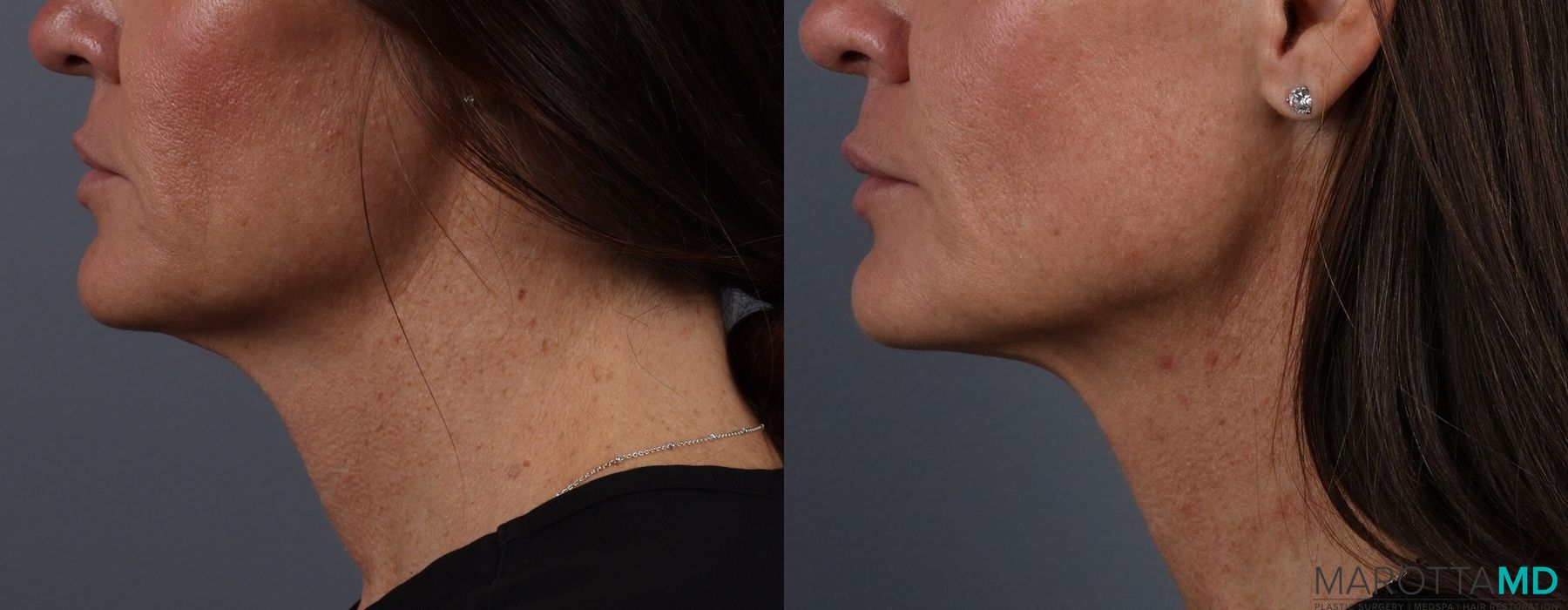 Botox - Nefertiti Neck Lift - Thumbnail 3