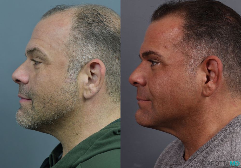 Before and after Hair Growth Serum case 7198 - Angle 2