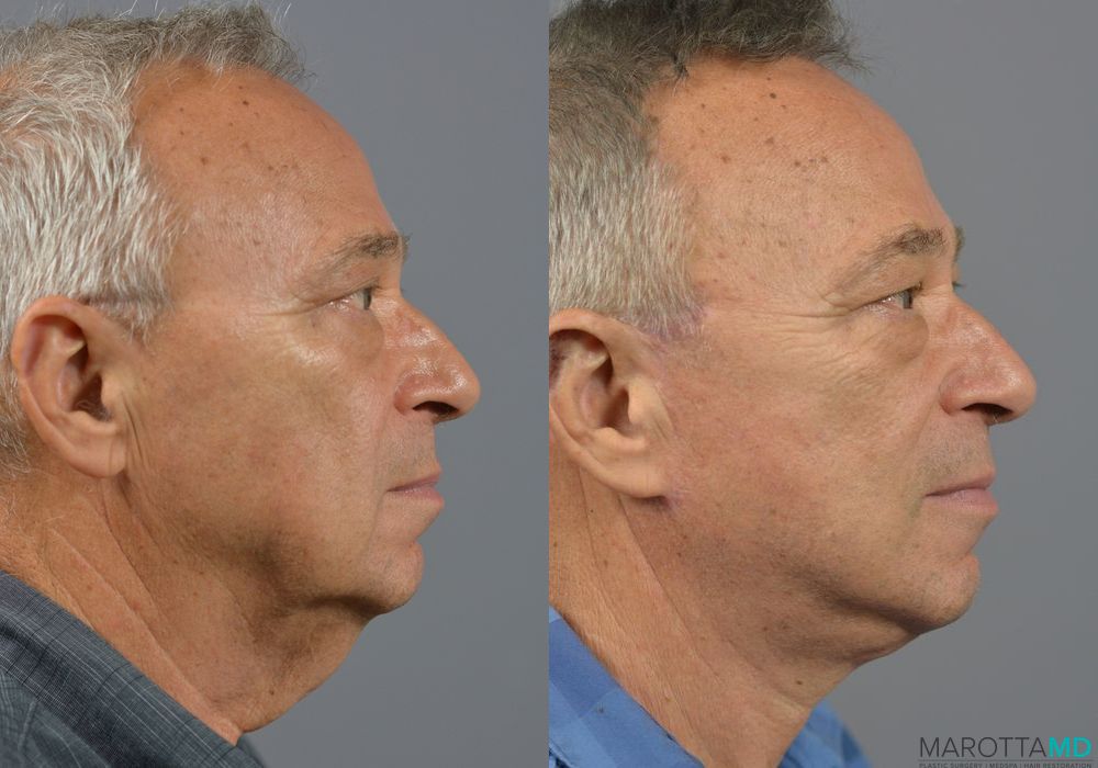 Facelift & Neck Lift - Thumbnail 5