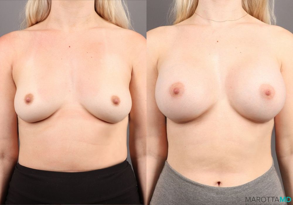 Breast Augmentation - Case 126