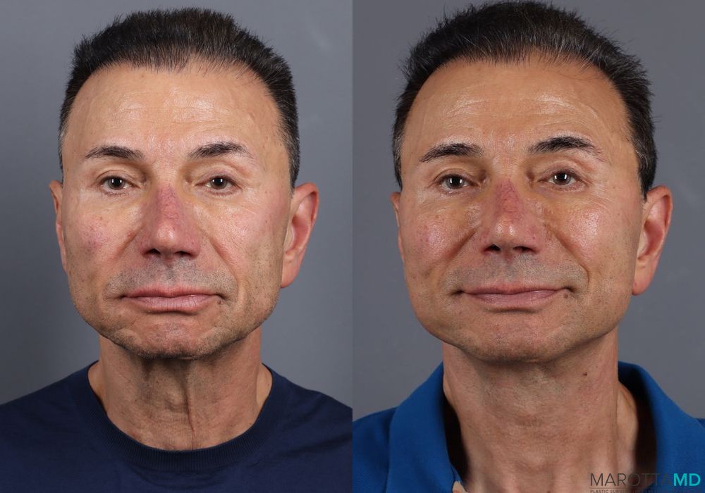 Before and after Facelift & Neck Lift case 7115