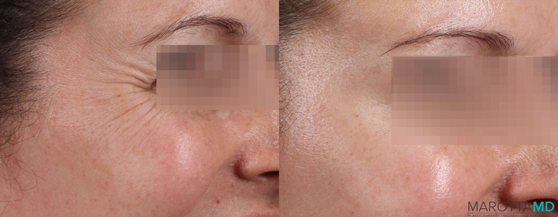 Before and after Botox - Glabella case 7187 - Angle 3