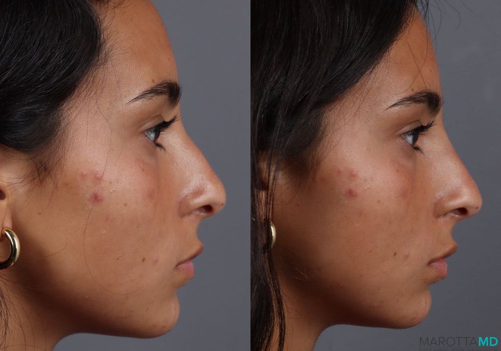 Non-Surgical Rhinoplasty - Case 407