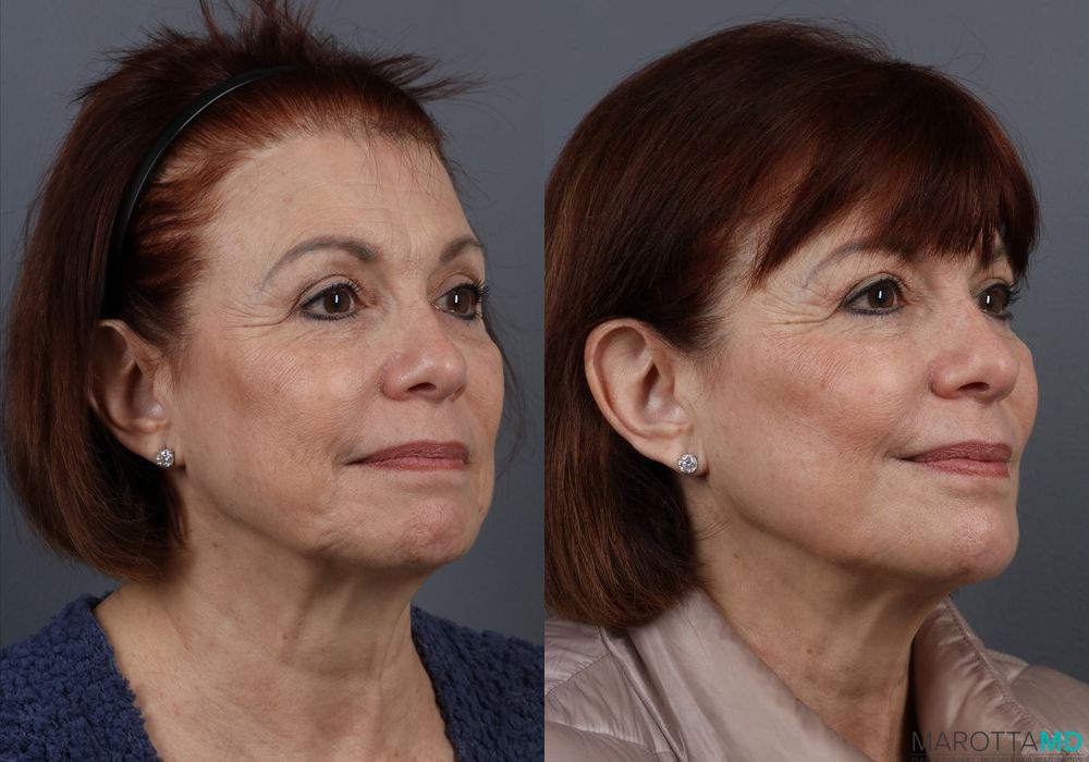 Botox - DAO - Thumbnail 3