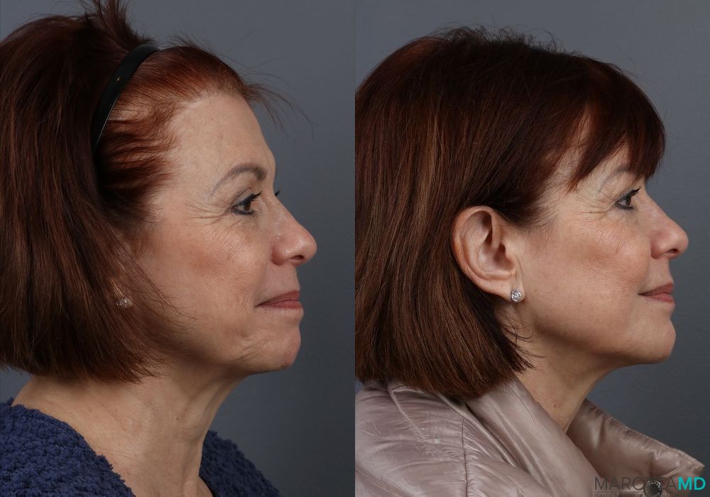 BOTOX® Cosmetic - Thumbnail 2