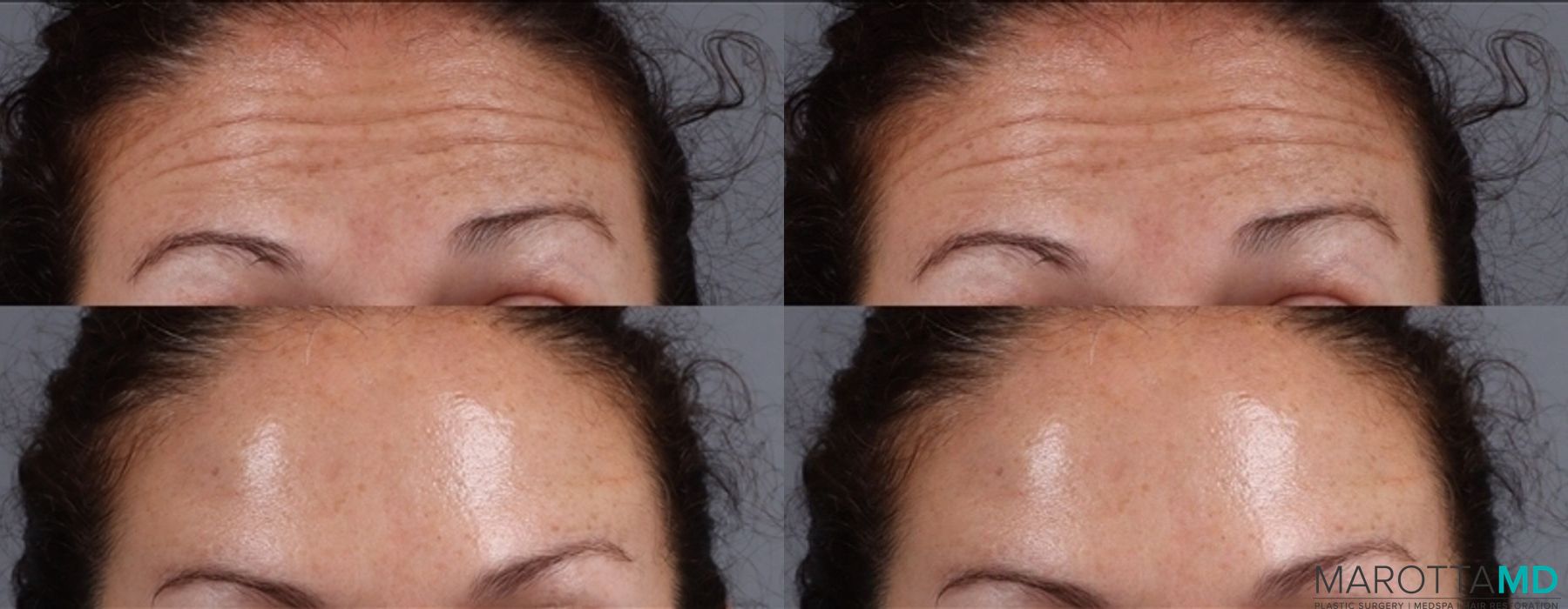 Before and after Botox - Chin case 7195 - Angle 2