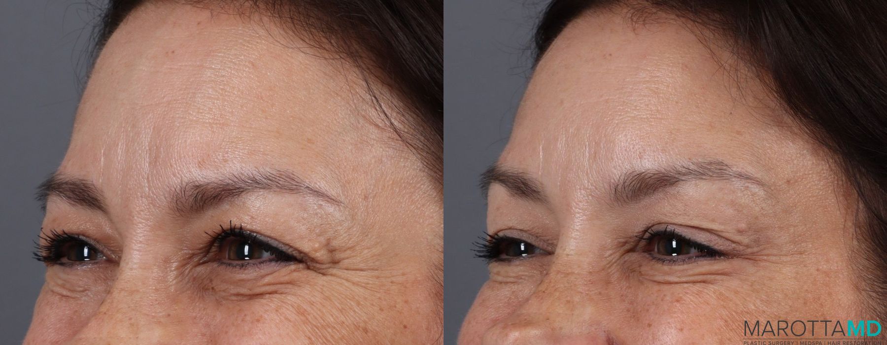 Botox - Crow's Feet - Thumbnail 4