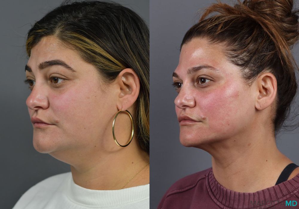 Renuvion - Thumbnail 5