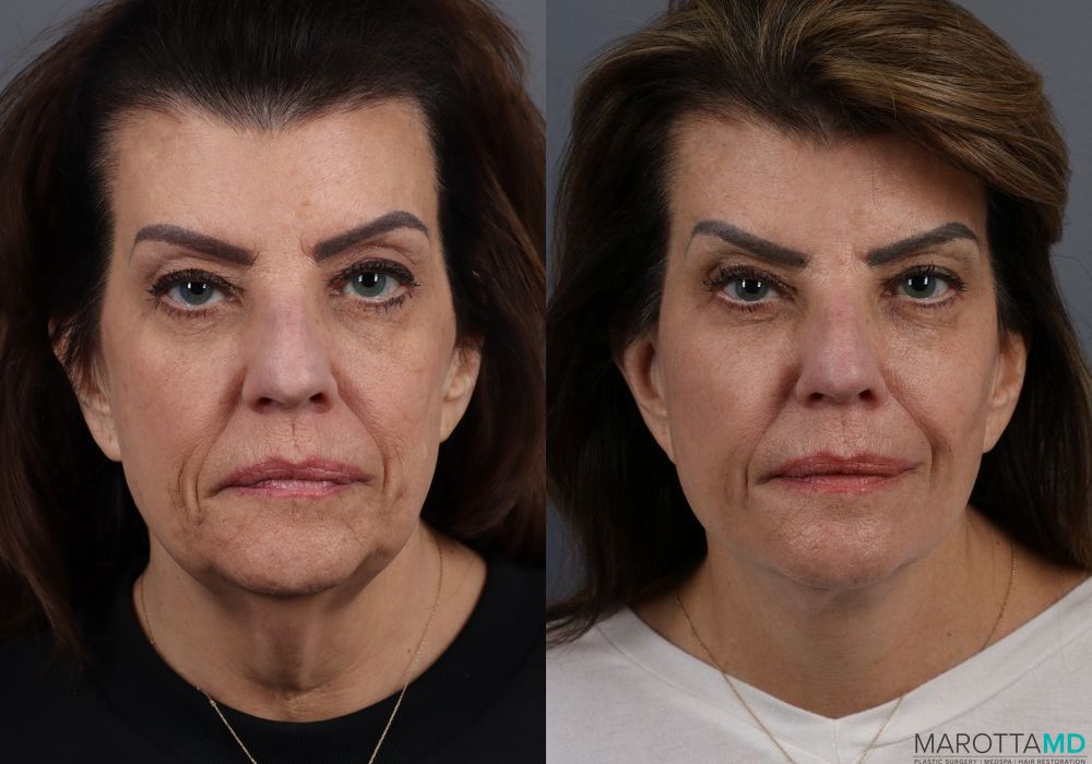 Facelift & Neck Lift - Case 202