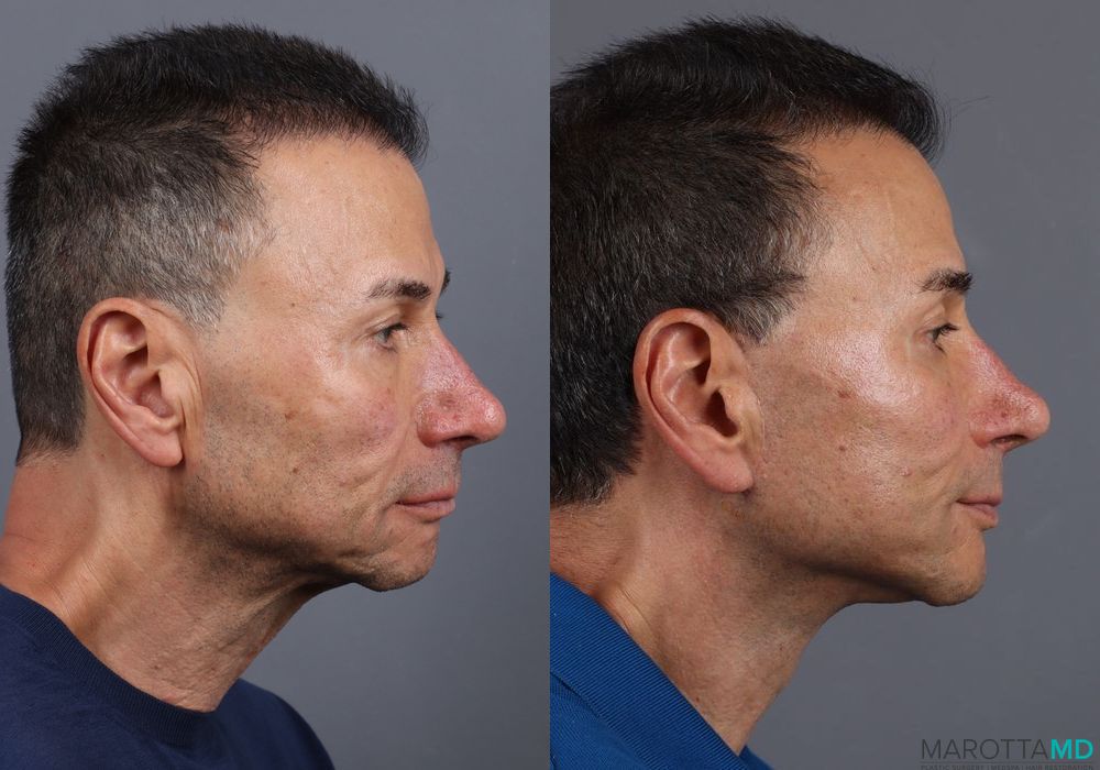 Before and after Facelift & Neck Lift case 7115 - Angle 3