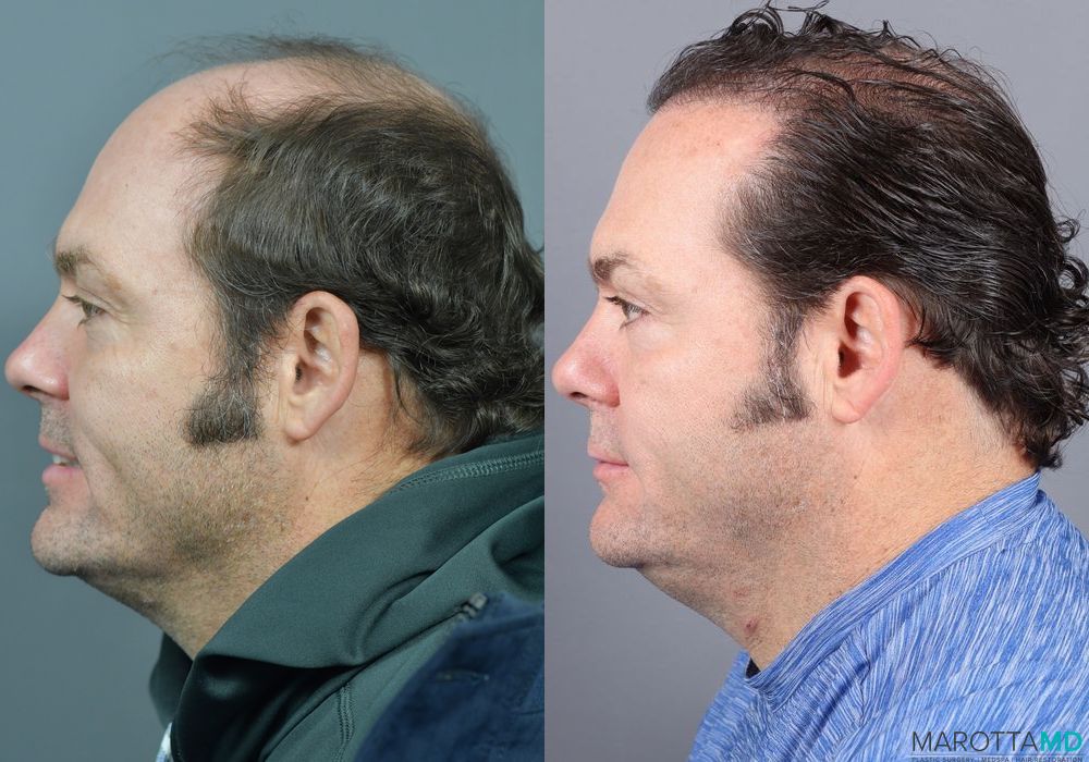 Hair Transplantation - Case 279