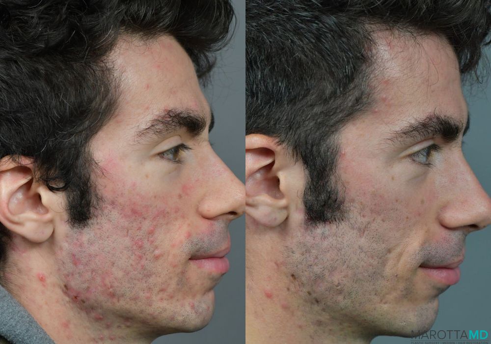 Genius Radio Frequency Microneedling - Thumbnail 3