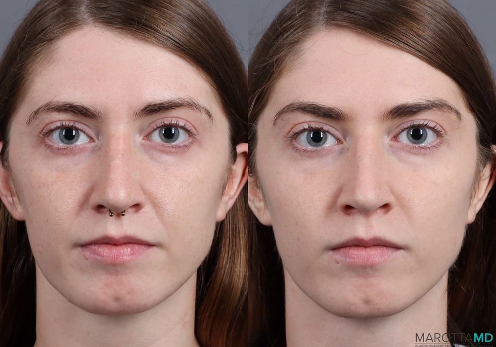 Juvederm / Fillers - Case 405