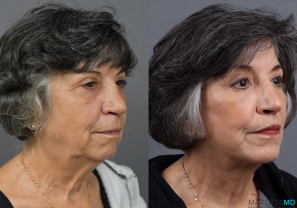 Before and after Chin Implant case 7027 - Angle 2