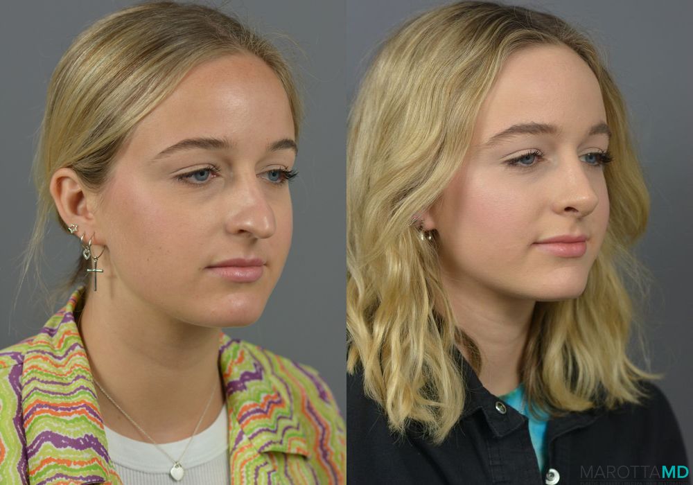 Rhinoplasty - Thumbnail 2