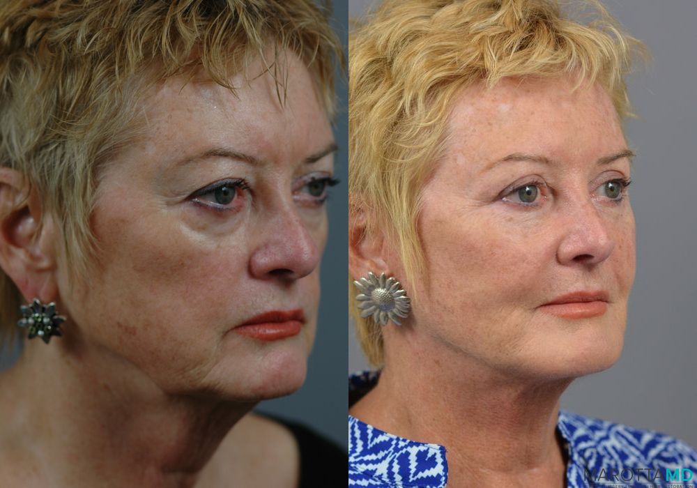 Facelift & Neck Lift - Thumbnail 2