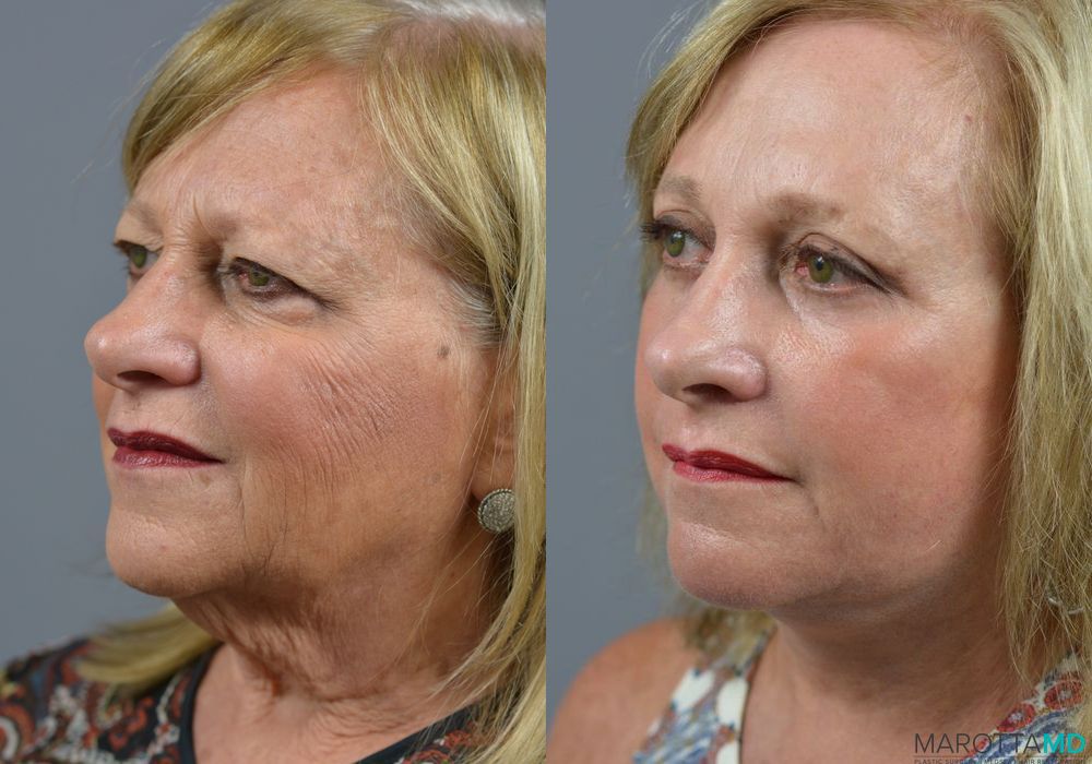 Facelift & Neck Lift - Thumbnail 2