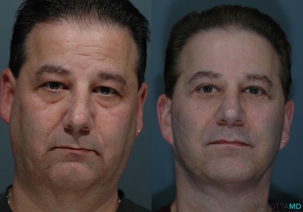 Facelift & Neck Lift - Case 198