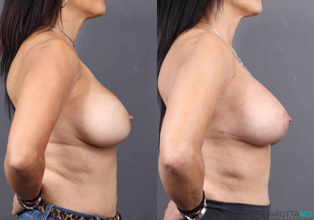 Breast Lift - Case 138