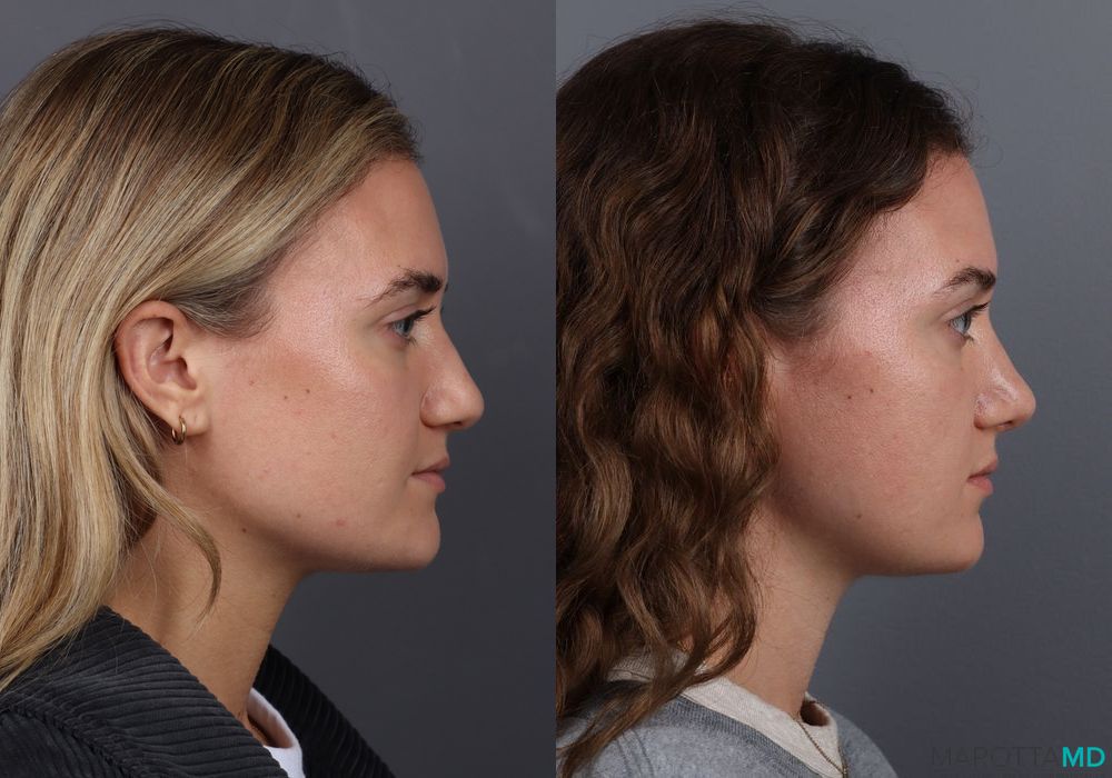 Rhinoplasty - Case 251