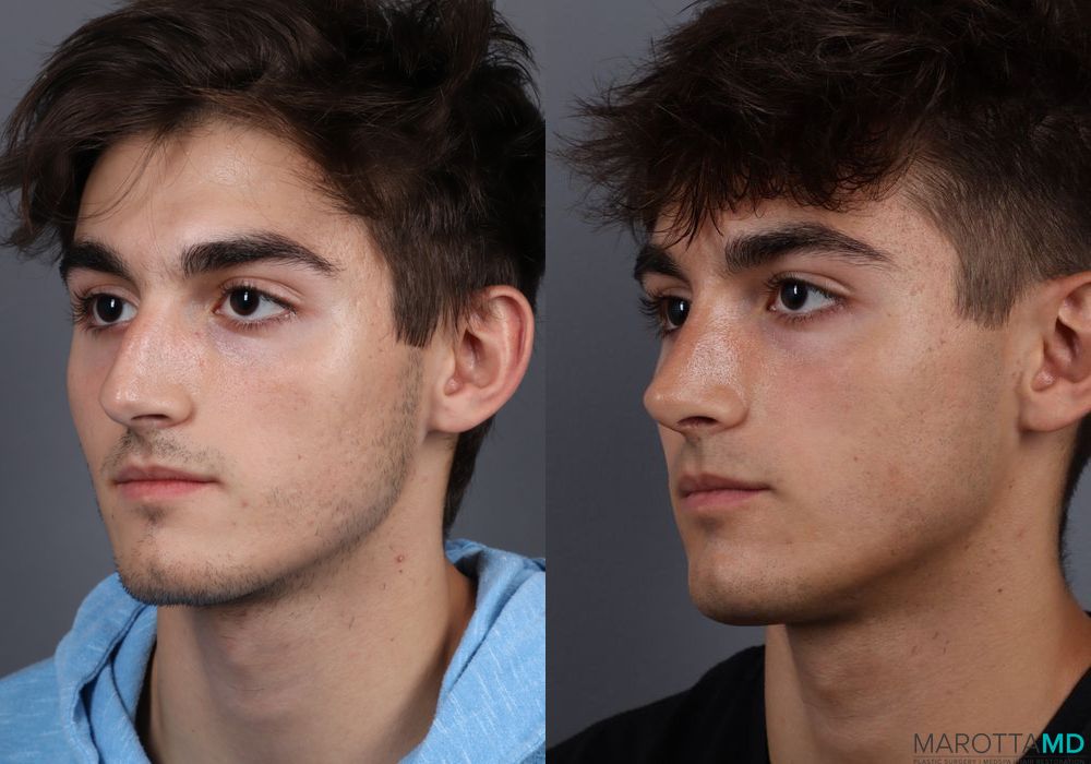 Before and after Male Rhinopolasty case 7015 - Angle 3