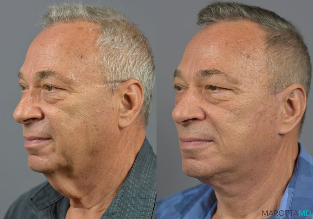 Facelift & Neck Lift - Thumbnail 4