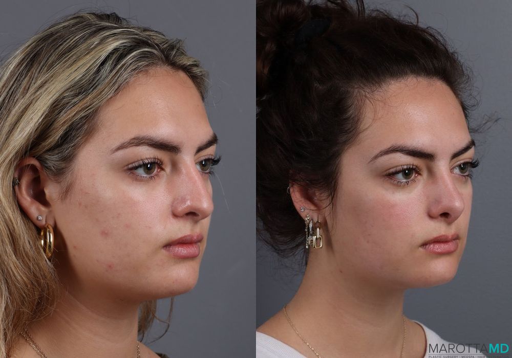 Before and after Rhinoplasty case 7250 - Angle 2