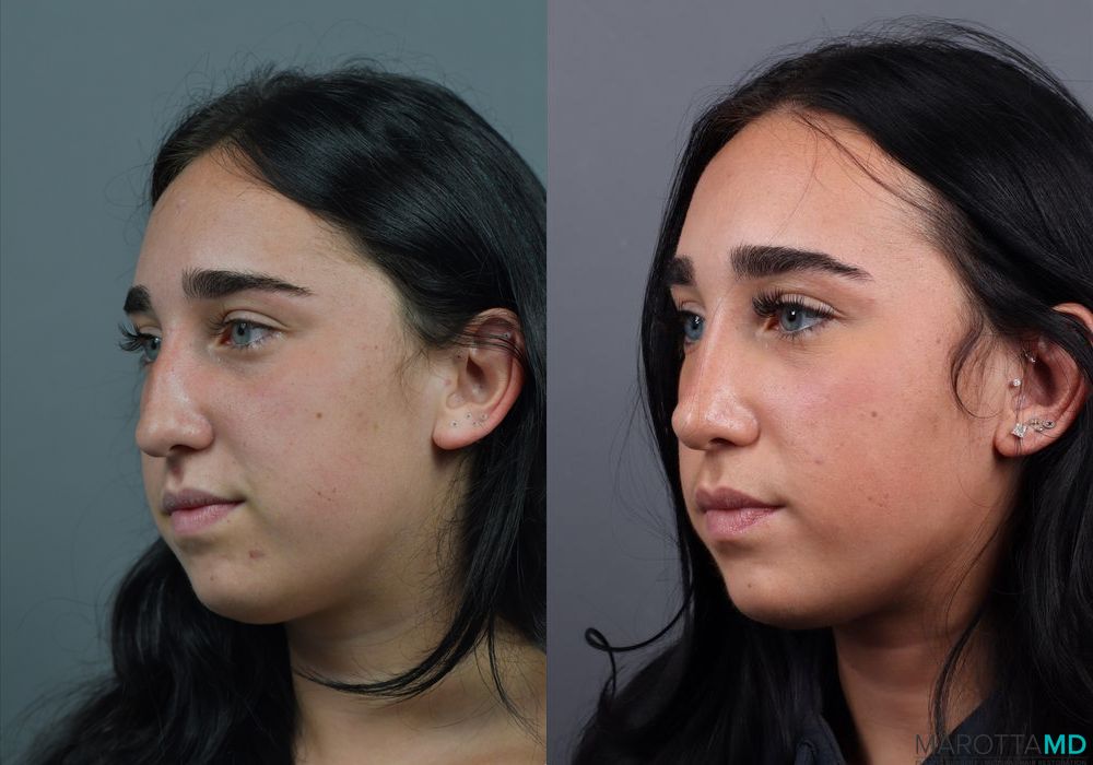 Before and after Rhinoplasty case 7286 - Angle 4