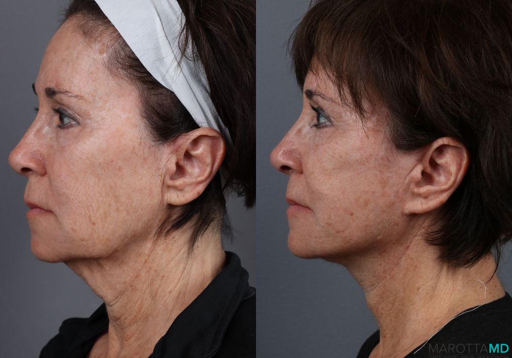 Facelift & Neck Lift - Thumbnail 4