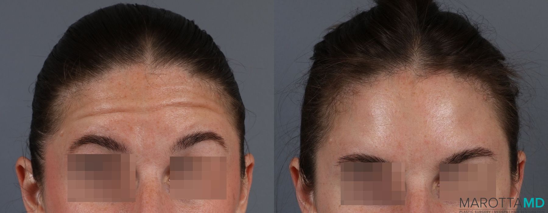 Before and after Botox - Glabella case 7188