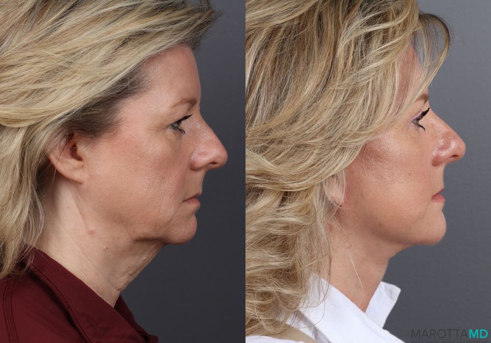 Before and after Fat Transfer - Face case 7263 - Angle 3
