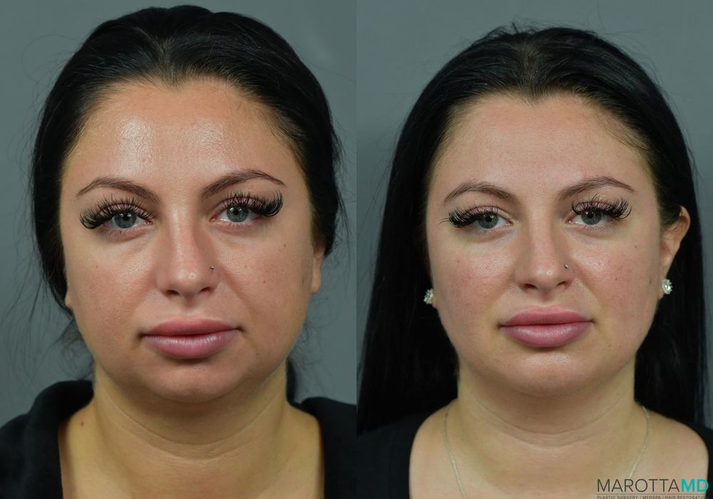 Buccal Fat Removal - Thumbnail 3